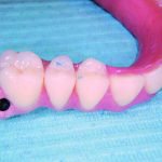 Impianti dentali senza osso a Brescia EAGLE GRID